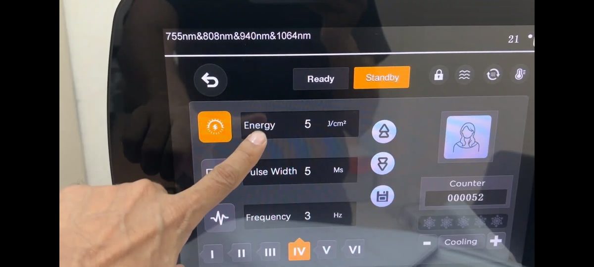 The laser console with skin types I to VI, type IV selected, and energy, pulse width and frequency settings.