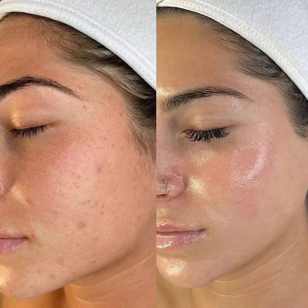 Hydrafacial treatment before after results in mumbai at mumbai cosmetic centre